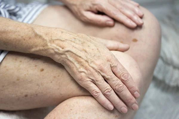 Hands Spots Old Age — Stockfoto