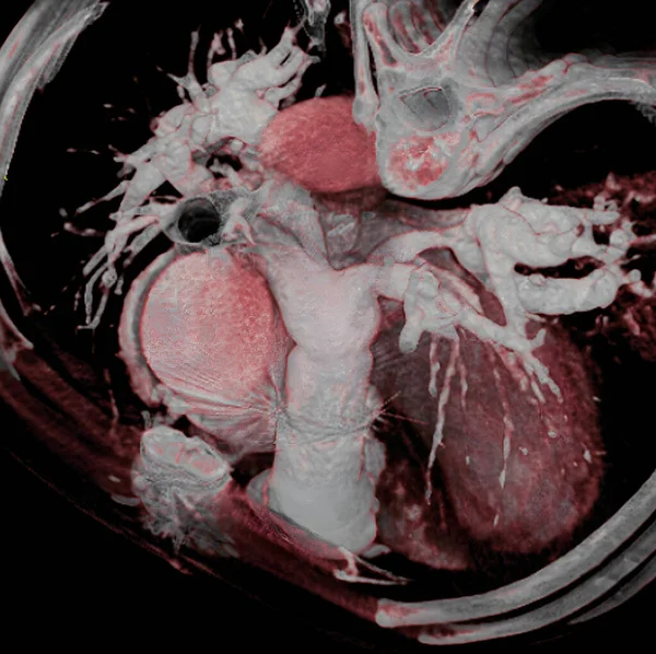 Patient Born Pulmonary Arteries Surgery Reconstructs Almost Normal Pulmonary Artery lizenzfreie Stockbilder