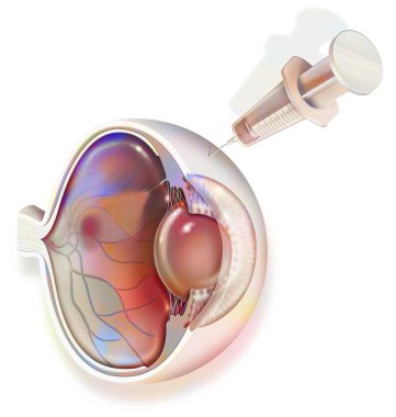 Eye: treatment of macular degeneration by RNA interference.