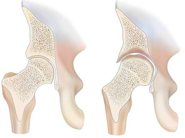 Healthy ankle and ankle with hemophilic arthropathy in frontal cut.