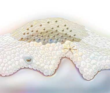 Wart, benign skin tumor caused by human papillomavirus virus.