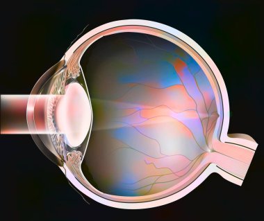 Eye: sagittal section of a lens with severe cataract.