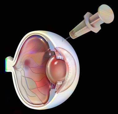 Eye: treatment of macular degeneration by RNA interference.