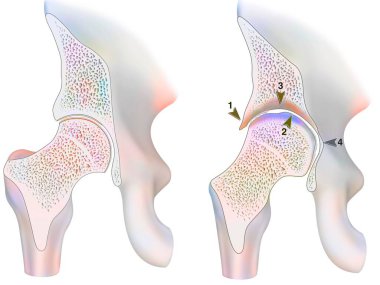 Healthy ankle and ankle with hemophilic arthropathy in frontal cut.