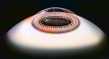 Eye, surgery, radial keratotomy: corneal incisions with a diamond knife.