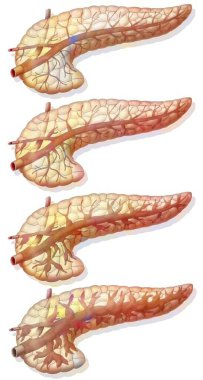 Evolution of the lesion of the pancreatic duct.