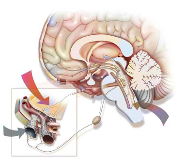 Migraine is thought to be caused by stimulation of the trigeminal nerve.
