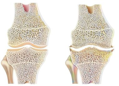 Healthy knee with osteoarthritis with degradation and abrasion of cartilages.