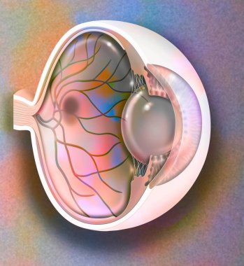 Age-related macular degeneration affecting the macula, the central area of the retina.