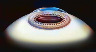 Eye, surgery, Lasik step 5: the corneal flap replaced.