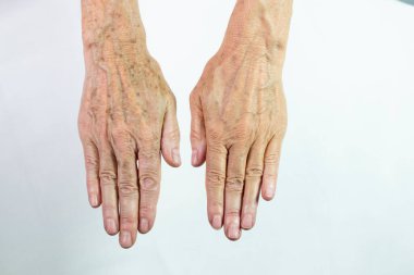 One hand with spots of old age and the other one laser treated