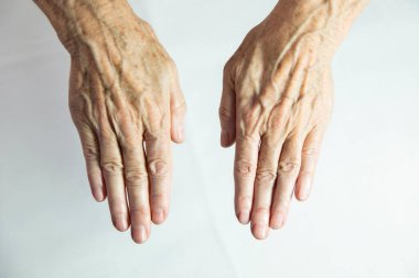 Hands with spots of old age