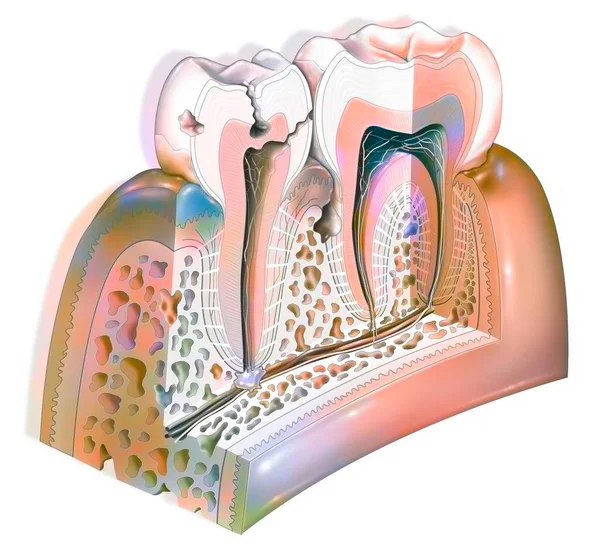 Dental Plaque Main Pathologies Teeth Tartar Gingivitis Decay — Stock fotografie