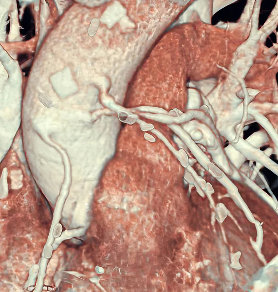 Scan Coronary Bypasses — Stok fotoğraf
