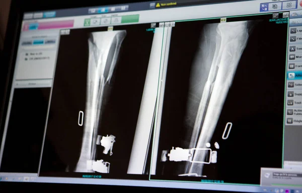 Ray Leg Patient Who Had Ski Fall Fractured Tibia Fibula — 图库照片