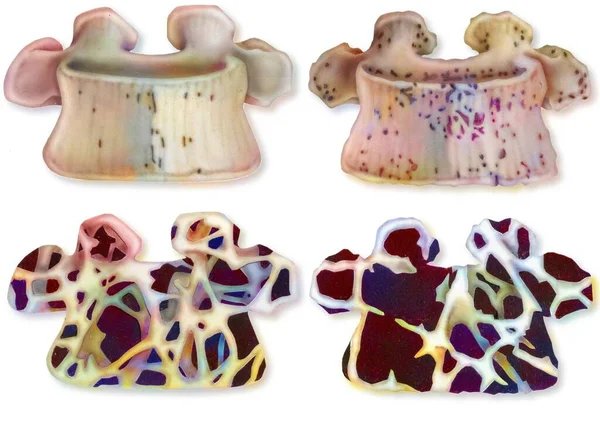 Osteoporosis Comparison Structure Young Vertebra Old Vertebra —  Fotos de Stock