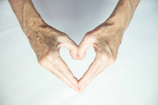 One Hand Spots Old Age Other One Laser Treated — Stockfoto