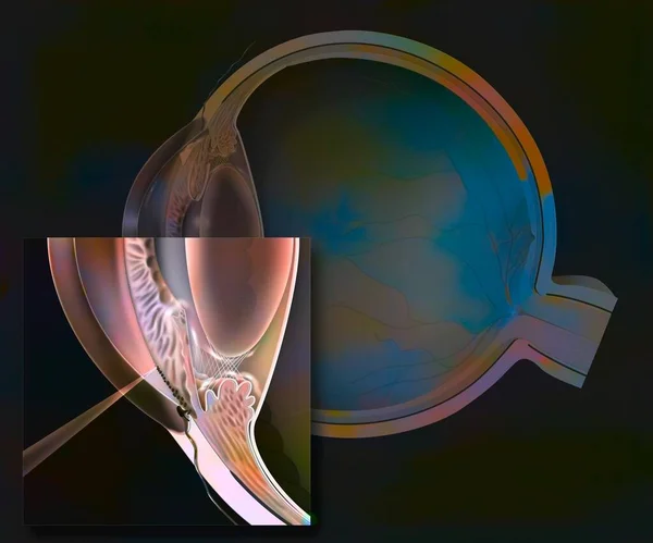Glaucoma Glaucomatous Eye Zoom Operation Trabeculoplasty — Stockfoto