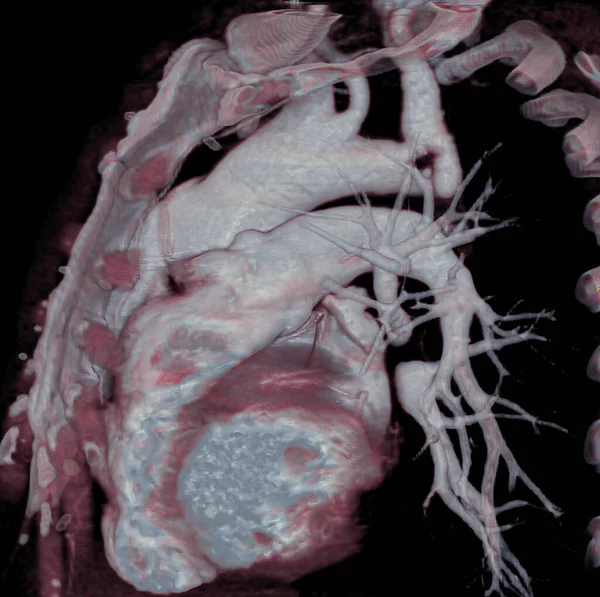 Pulmonary arteries and Mediastinum, heart, and aorta are visible, 3D CT scan.