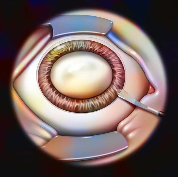 Eye Cataract Phacoemulsification Step Making Self Sealing Incision — Stockfoto