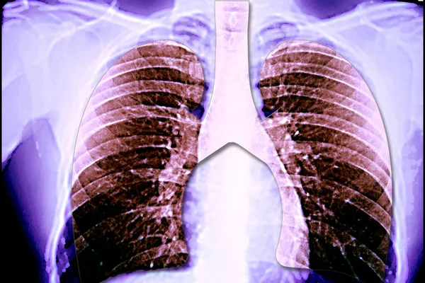 Lung Ray Result — Stock Fotó