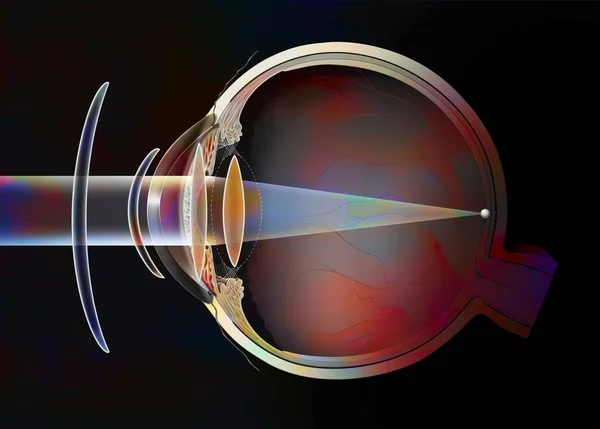 Different Possible Corrections Presbyopic Eye Spectacle Lenses External Lenses — Foto Stock