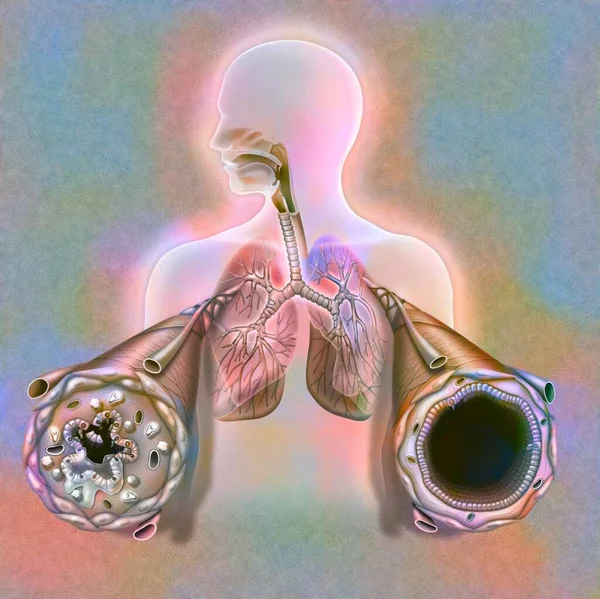 Condition Bronchi Asthma Attack — Photo