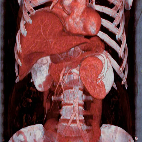 Ectopic Spleen Spleen Tipped Downwards Scan Anomalous Position Pathological — Foto Stock