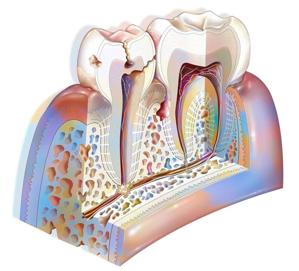 Dental Plaque Main Pathologies Teeth Tartar Gingivitis Decay — Stock Photo, Image