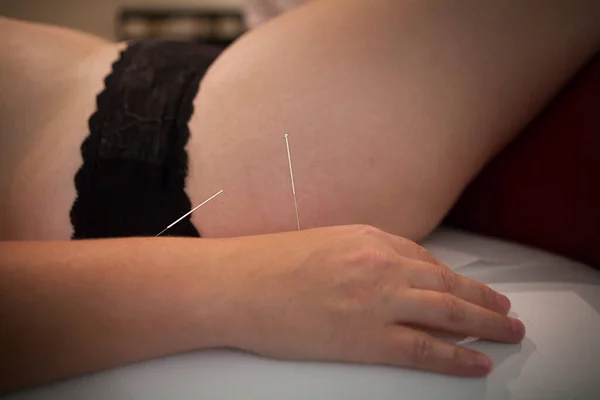 Therapist Specializing Traditional Chinese Medicine Practicing Acupuncture — Foto de Stock