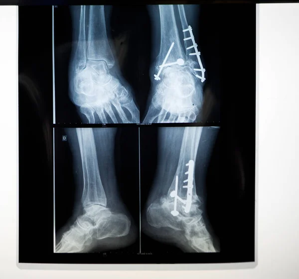 Osteosynthesis Septic Surgery Removal Internal Ankle Fixator Infection — Photo