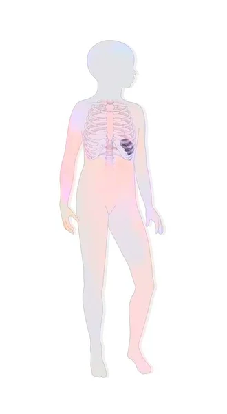 Location Spleen Rib Cage Child Silhouette — Stockfoto