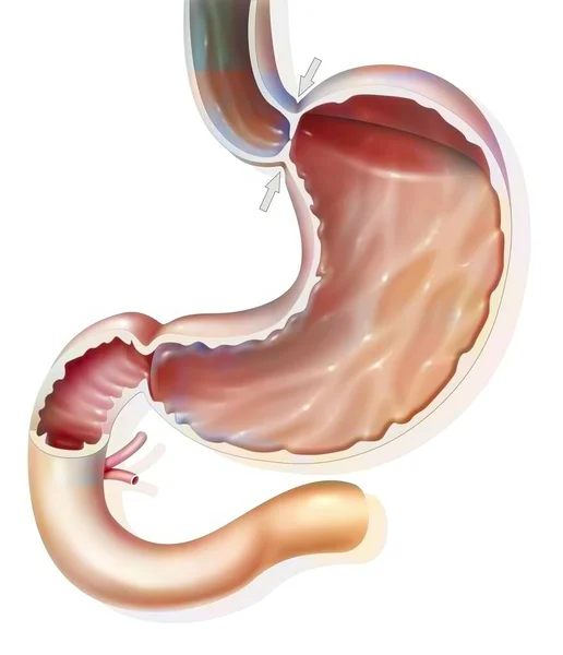Stomach Normal Hermetic Gastroesophageal Sphincter Preventing Gastroesophageal Reflux — 스톡 사진