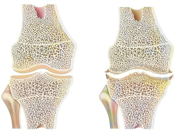 Healthy Knee Osteoarthritis Degradation Abrasion Cartilages — Fotografia de Stock