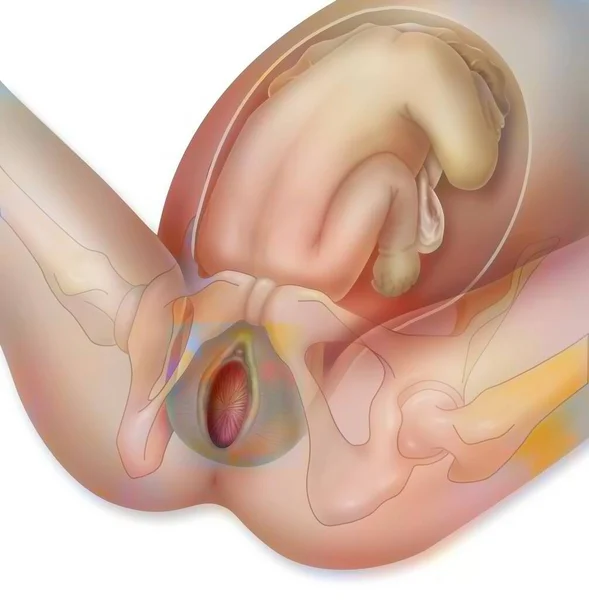 Childbirth Step Baby Head Pushes Edges Vulva Apart — 图库照片