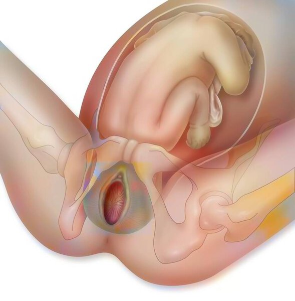 Рождение ребенка, шаг 2: голова ребенка толкает края вульвы друг от друга.