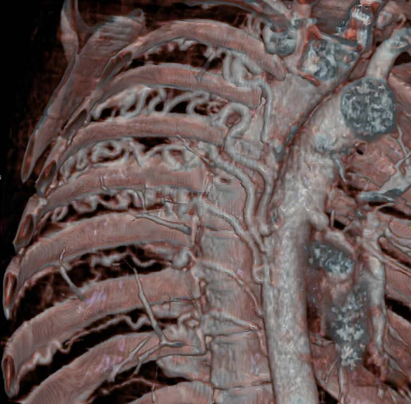 Large Intercostal Arteries Visible Scan Developed Compensate Pulmonary Blood Flow — Stockfoto