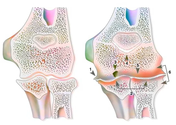 Comparison Healthy Elbow Hemophilic Arthropathy Hemarthrosis — Foto Stock