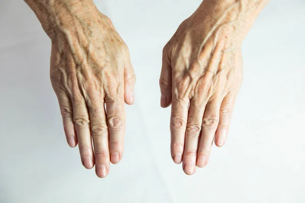 Hands Spots Old Age — Stockfoto