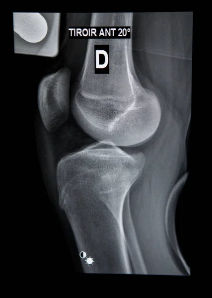 Radiology Center Telos Dynamic Radiography Knee Ruptured Ligament — ストック写真