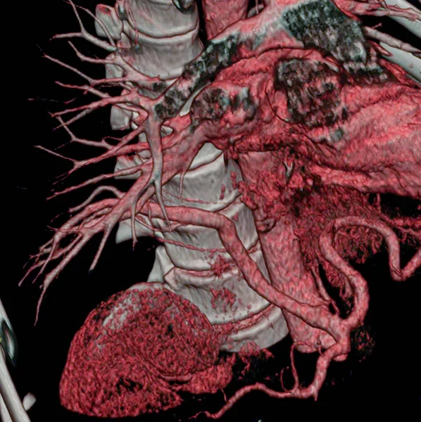 Abnormal Vessel Originating Abdominal Aorta Vascularizing Right Lung Anomaly Called Stockfoto