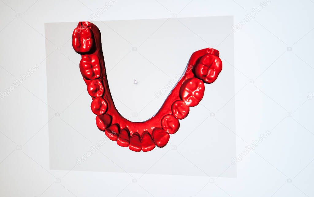 Report in a dental prosthesis laboratory that uses a Computer Aided Design Manufacturing (CAD / CAM) system and is equipped with a Zirkonzahn CAD / CAM. This system makes it possible to scan dental impressions and thus obtain a 3D image. From this im