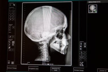 X-ray of a child's skull, prescribed by his orthodontist.