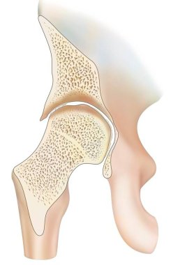 Ankle affected by hemophilic arthropathy in frontal cut.
