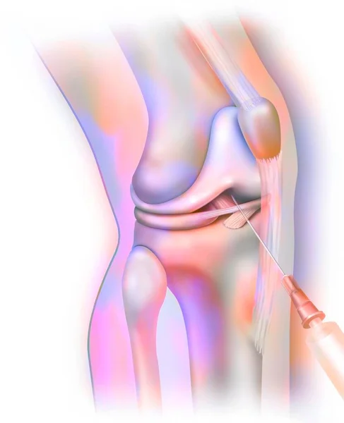 Knee Joint Arthrography Injection Contrast Product Make Structures Visible Radio — Photo