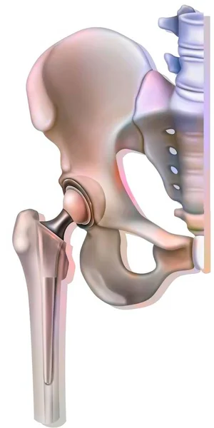 Bone System Hip Prosthesis — Zdjęcie stockowe