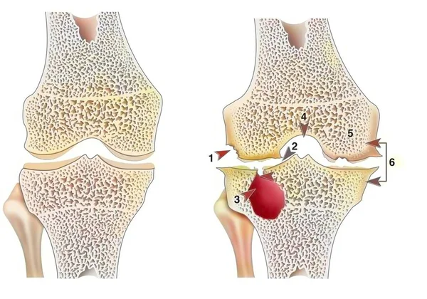 Healthy Knee Hemophilic Arthropathy Frontal Cut — Foto de Stock