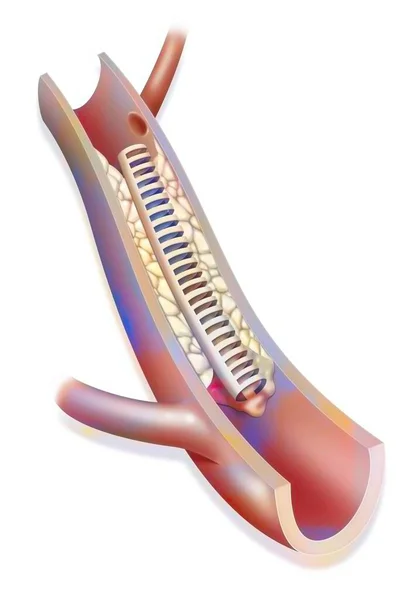 Coronary Angioplasty Stent Placement Step Catheter Removed — Foto Stock