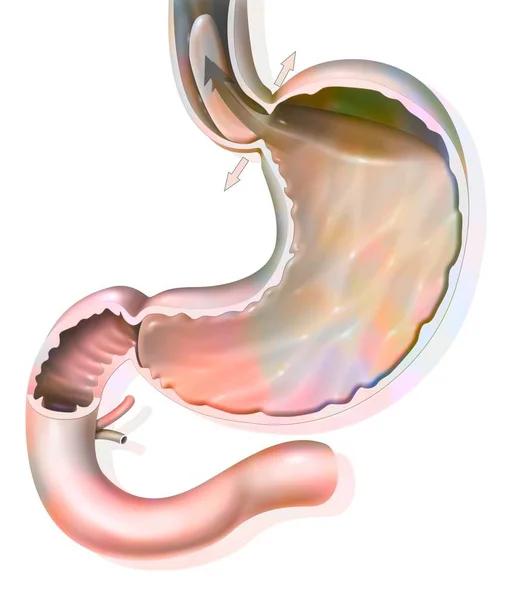 Stomach Gastroesophageal Reflux Disease Gastroesophageal Sphincter — Photo