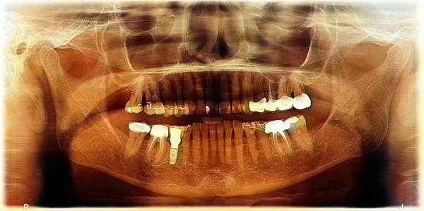 Dental panoramic of a 72 year old person with an implant and crowns.